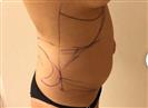 Tummy Tuck (Abdominoplasty) - Estethica Surgical Medical Center