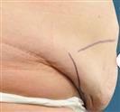 Tummy Tuck (Abdominoplasty) - Estethica Surgical Medical Center