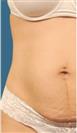Tummy Tuck (Abdominoplasty) - Estethica Surgical Medical Center