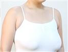 Breast Lift - Banobagi Plastic Surgery
