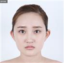 Genioplasty - Banobagi Plastic Surgery