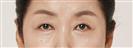Eye Plastic Surgery - Banobagi Plastic Surgery