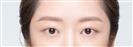 Eye Plastic Surgery - Banobagi Plastic Surgery