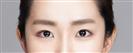 Eye Plastic Surgery - Banobagi Plastic Surgery