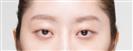 Eye Plastic Surgery - Banobagi Plastic Surgery