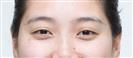 Eye Plastic Surgery - Banobagi Plastic Surgery