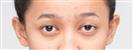 Eye Plastic Surgery - Banobagi Plastic Surgery