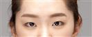 Eye Plastic Surgery - Banobagi Plastic Surgery