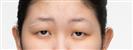 Eye Plastic Surgery - Banobagi Plastic Surgery