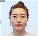 Facelift - Banobagi Plastic Surgery