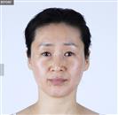 Facelift - Banobagi Plastic Surgery