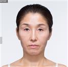 Facelift - Banobagi Plastic Surgery
