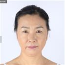 Facelift - Banobagi Plastic Surgery