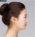 Forehead Volume - Banobagi Plastic Surgery