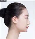 Forehead Volume - Banobagi Plastic Surgery