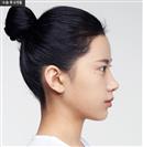 Forehead Volume - Banobagi Plastic Surgery