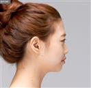 Forehead Volume - Banobagi Plastic Surgery