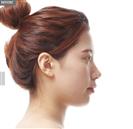 Forehead Volume - Banobagi Plastic Surgery