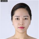 Zygoma Reduction - Banobagi Plastic Surgery