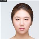 Zygoma Reduction - Banobagi Plastic Surgery