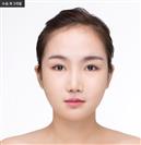 Square Jaw Reduction - Banobagi Plastic Surgery