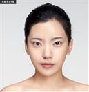 Zygoma Reduction - Banobagi Plastic Surgery