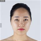 Zygoma Reduction - Banobagi Plastic Surgery