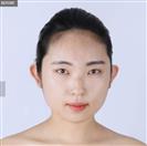 Zygoma Reduction - Banobagi Plastic Surgery