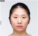 Zygoma Reduction - Banobagi Plastic Surgery