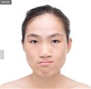 Square Jaw Reduction - Banobagi Plastic Surgery