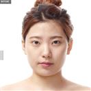 Zygoma Reduction - Banobagi Plastic Surgery