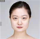 Square Jaw Reduction - Banobagi Plastic Surgery