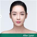 Anterior Segmental Osteotomy (A.S.O.) - Banobagi Plastic Surgery