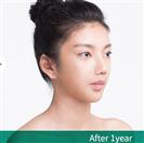 Anterior Segmental Osteotomy (A.S.O.) - Banobagi Plastic Surgery