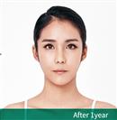 Anterior Segmental Osteotomy (A.S.O.) - Banobagi Plastic Surgery