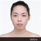 Anterior Segmental Osteotomy (A.S.O.) - Banobagi Plastic Surgery