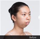 Anterior Segmental Osteotomy (A.S.O.) - Banobagi Plastic Surgery