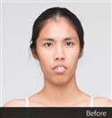Anterior Segmental Osteotomy (A.S.O.) - Banobagi Plastic Surgery