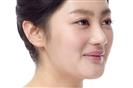 Rhinoplasty - Banobagi Plastic Surgery