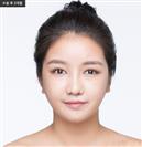 Nasolabial Fold Surgery - Banobagi Plastic Surgery