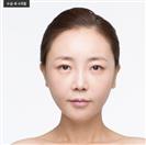 Nasolabial Fold Surgery - Banobagi Plastic Surgery
