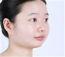 Rhinoplasty - Banobagi Plastic Surgery