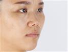 Rhinoplasty - Banobagi Plastic Surgery