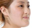 Rhinoplasty - Banobagi Plastic Surgery