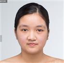 Nasolabial Fold Surgery - Banobagi Plastic Surgery