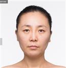 Nasolabial Fold Surgery - Banobagi Plastic Surgery
