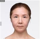 Nasolabial Fold Surgery - Banobagi Plastic Surgery