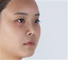 Rhinoplasty - Banobagi Plastic Surgery