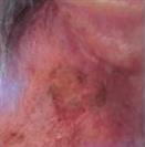 D.A.S. Medical - Keratosis - Turkeyana Clinic