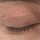 D.A.S. Medical - Eyelid Plasty (Blepharoplasty) - Turkeyana Clinic